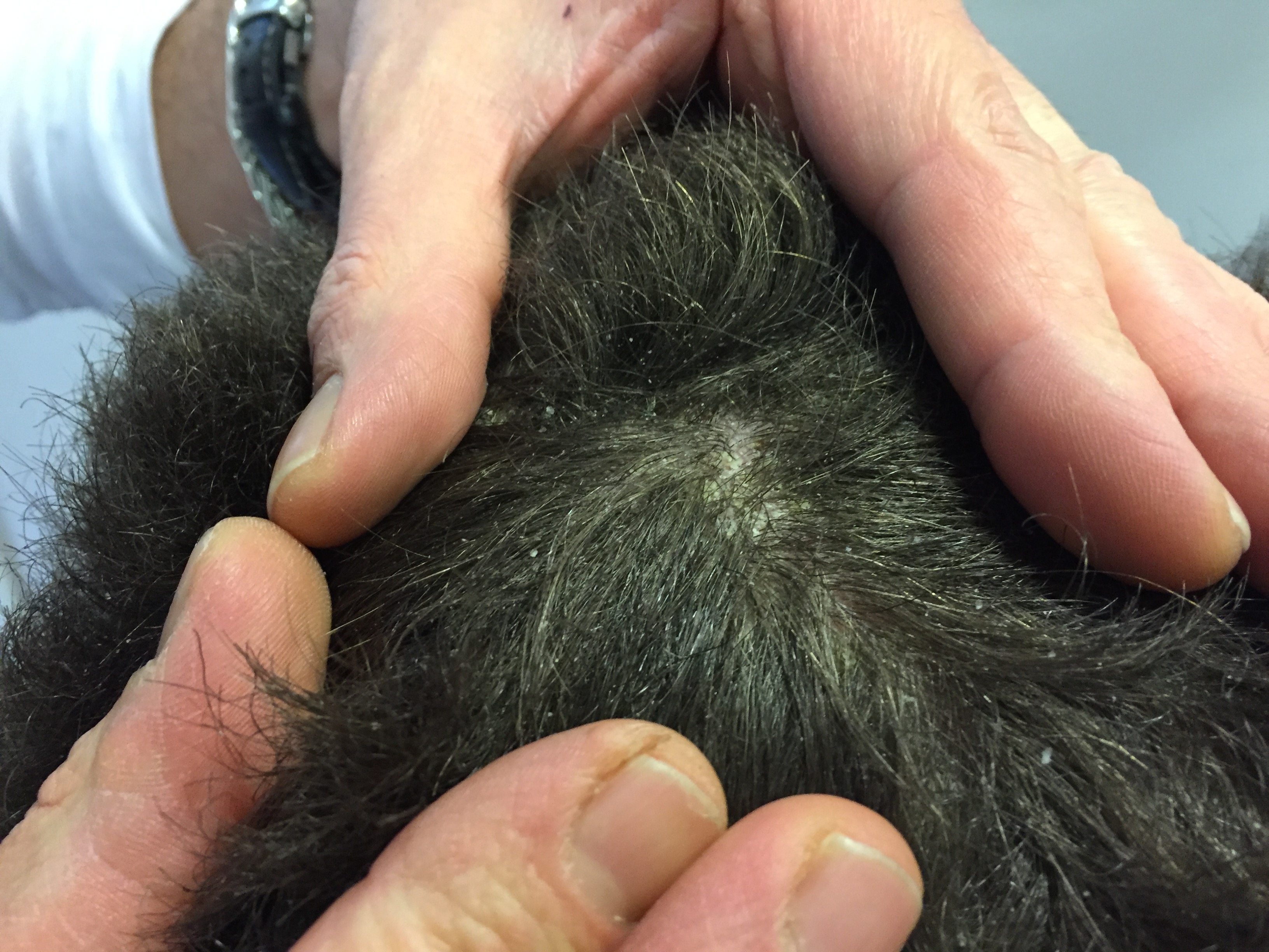 pellicules amas collant